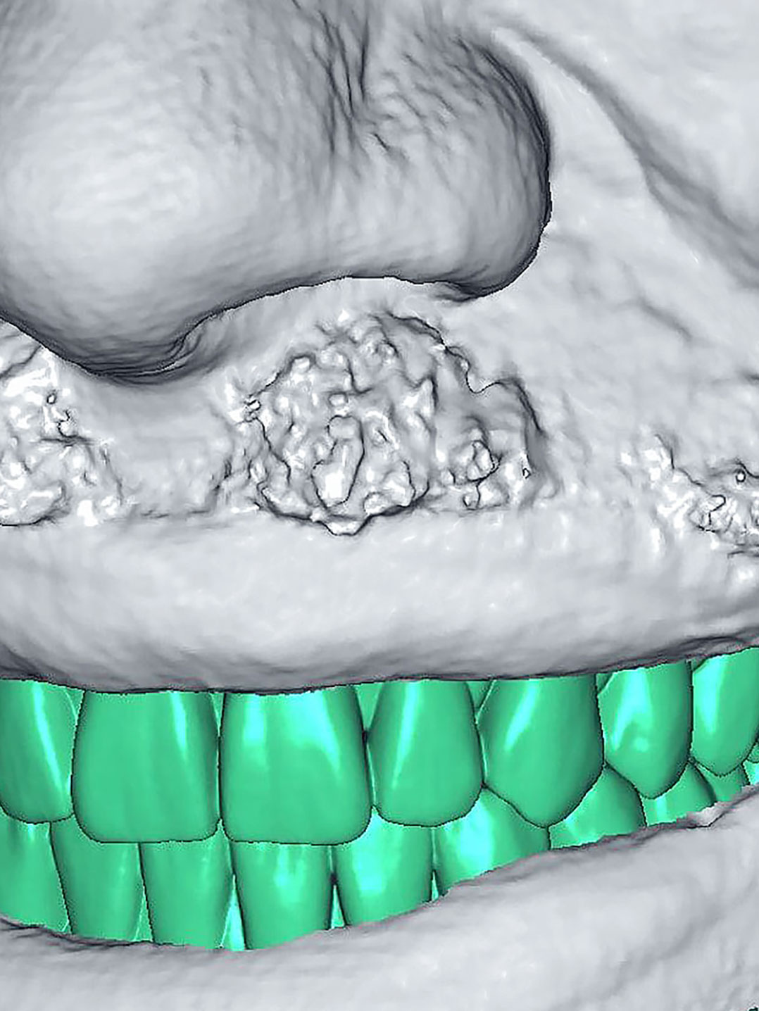 3D dental scanner Artec Space Spider helps give dental implant patients their perfect smiles